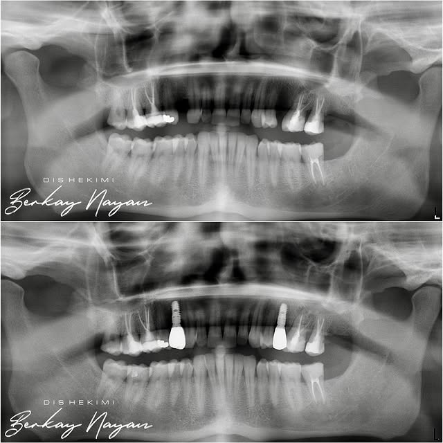 ✔️Üst çene tekli diş eksikliklerinin implant cerrahisi sonrası vidalı monolitik zirkonyum kronlar ile tamamlanması. ✔️H...
