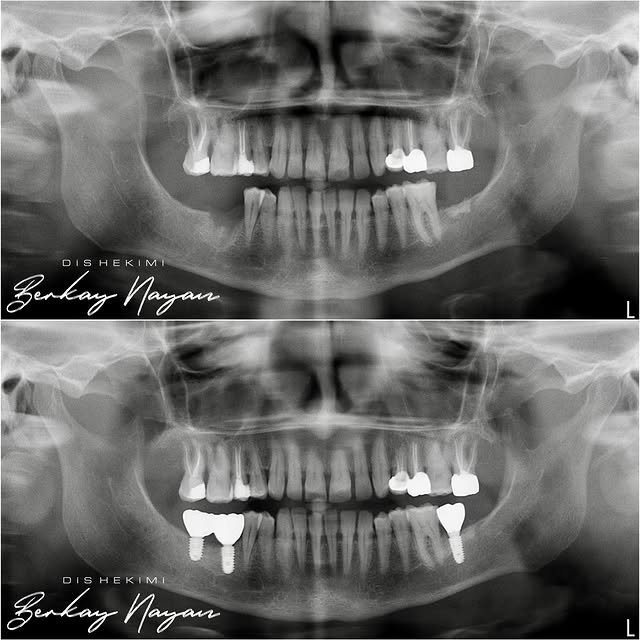 ✔️Alt çene sağ - sol posterior bölge diş eksikliklerinin implant cerrahisi sonrası vidalı monolitik zirkonyum kronlar i...